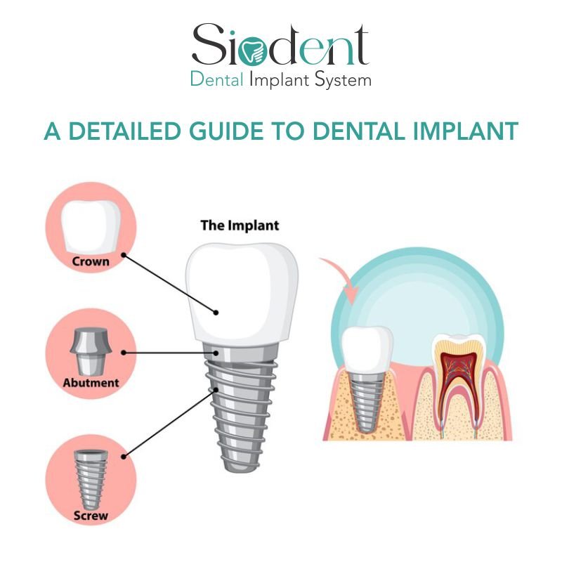 A Detailed Guide to Dental Implants